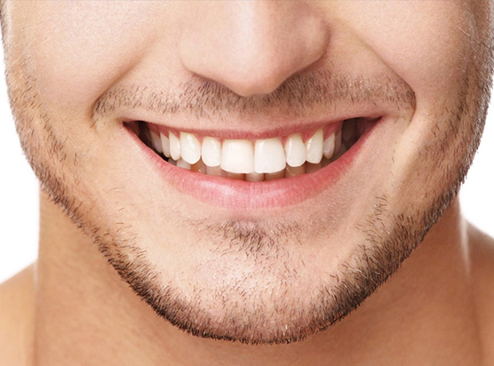 Faccette estetiche