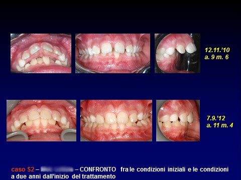 ortodonzia-invisibile ortodonzia-bambini
